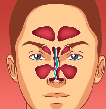 Deviazione del setto nasale